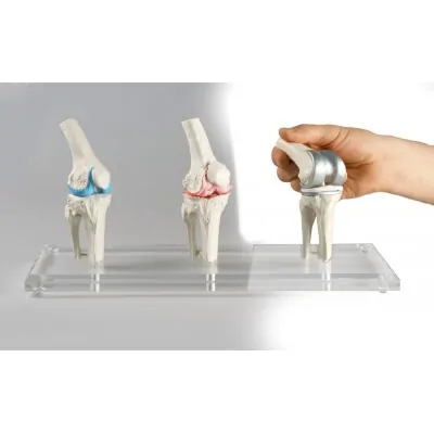Μοντέλο Αρθροπλαστικής Γόνατος - Knee Implant Model
