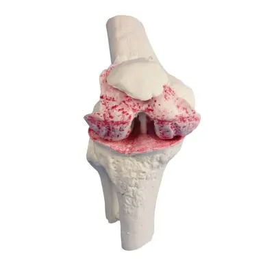 Μοντέλο Αρθροπλαστικής Γόνατος - Knee Implant Model