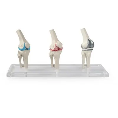 Μοντέλο Αρθροπλαστικής Γόνατος - Knee Implant Model