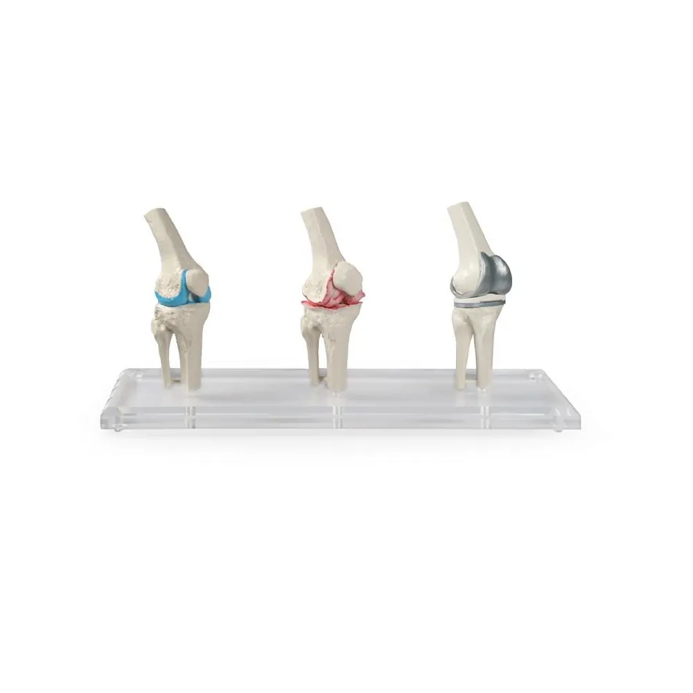 Μοντέλο Αρθροπλαστικής Γόνατος - Knee Implant Model Μοντέλο Αρθροπλαστικής Γόνατος - Knee Implant Model