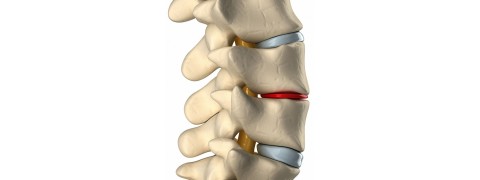 Πότε ένας εκφυλισμένος μεσοσπονδύλιος δίσκος μπορεί να προκαλέσει πόνο;