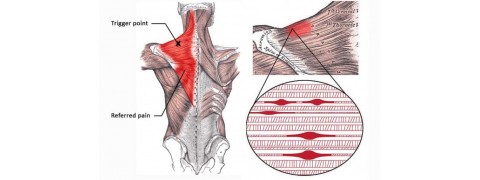 Trigger Points – Τι είναι και πώς αντιμετωπίζονται;